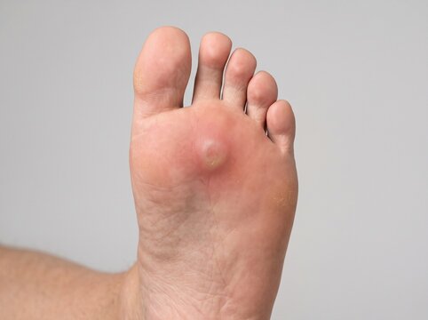 Ultra Realistic Close Up of Plantar Foot Abscess with Localized Swelling During Clinical Medical Examination