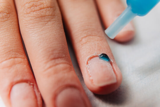 Closeup of a finger with a drop of blue medical liquid applied to the nail from an applicator tip showing skin texture and natural nail for healthcare and podiatry concepts