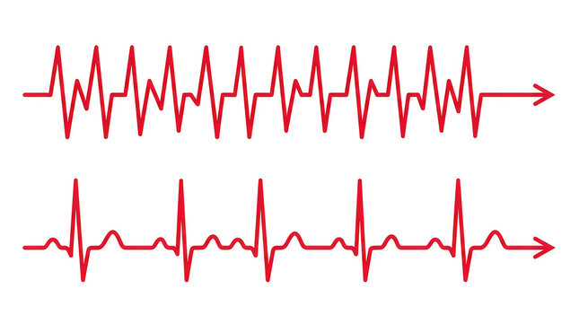 Two different heart rate electrocardiogram ecg rhythm strips