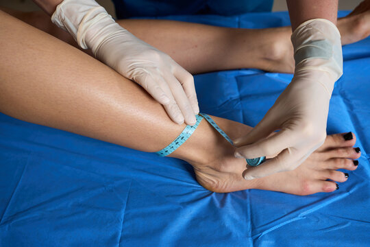 Vascular surgeon assesses lower limb swelling by measuring the ankle circumference of a patient with a blue tape measure