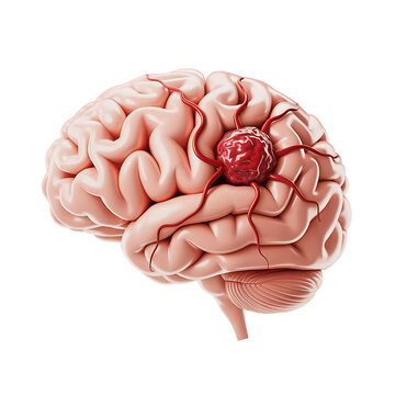 Detailed Human Brain Tumor with Blood Vessels Showing Cancerous Growth, Cerebral Anatomy, Neurological Disease and Medical Oncology Illustration