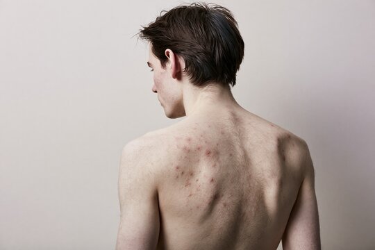 Upper back of a young man with skin blemishes and acne shown from behind for dermatology and skincare medical clinical analysis