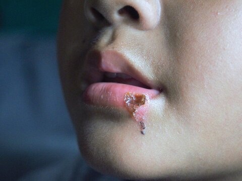 A close-up view of an Asian child's mouth showing a ruptured burn blister on the lower lip, now presenting with a thick yellowish-brown honey-colored crust from secondary infection.