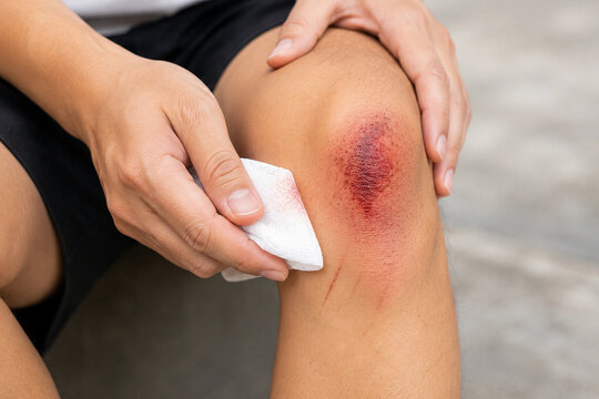 Close up of a person cleaning a bleeding scraped knee wound with white gauze after an accident, first aid treatment.