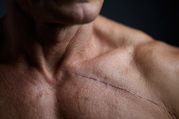 Naklejka premium Close up of patient chest showing faint well healed surgical scar from ICD implant symbolizing strength and survival, inspiring healthcare success story perfect for cardiac recovery journey concept.