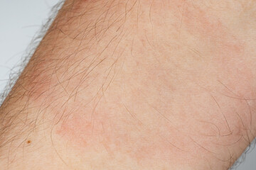 Fototapeta premium Medical symptom of Lyme disease with characteristic red ring rash on human body