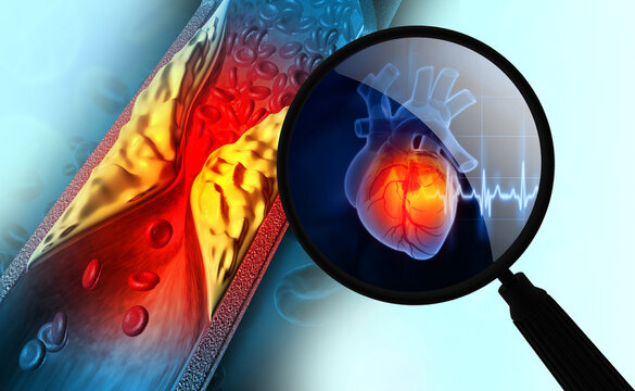 Clogged arteries, Cholesterol plaque in artery, atherosclerosis disease, Heart attack. 3d illustration