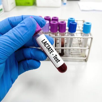 lactate test written on a label of a blood collection tube in a clinical laboratory.