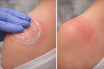 Fototapeta premium Gloved hand applying cooling gel to red shoulder after sunburn treatment