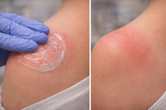 Gloved hand applying cooling gel to red shoulder after sunburn treatment