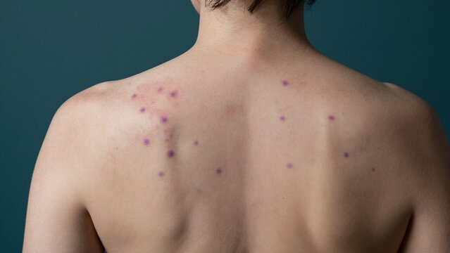 Close-up of a person's bare back showing multiple purple insect bite marks against a solid teal background.