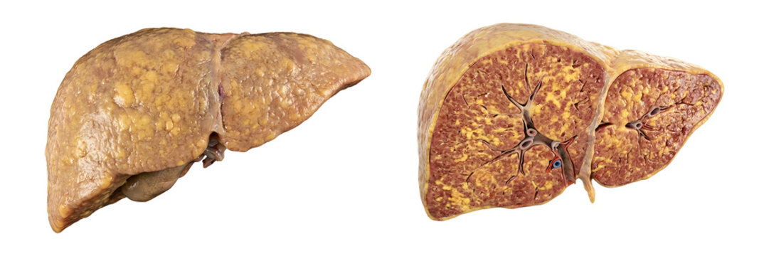 PNG Fatty Liver Disease Cross Section Anatomy Isolated on Transparent Background