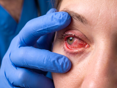 Doctor in blue glove holding open an eyelids to inspect a severely red and inflamed bloodshot eye during a medical examination
