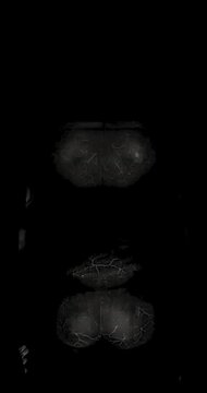 Vertical medical animation of a coronal T2 fat saturated whole body MRI with bright kidneys spine and brain scrolling through slices on a dark clinical background.