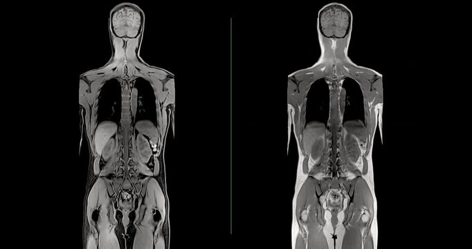 Wide monochrome medical animation of a whole body MRI coronal sequence advancing from anterior organs to posterior spine slices on a black background.
