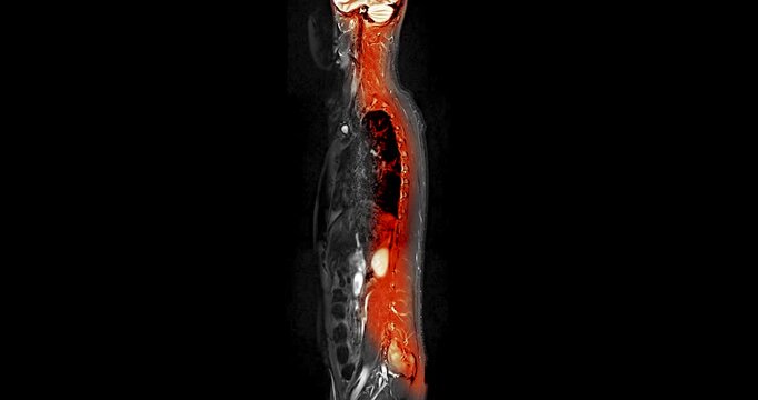 Wide medical animation of a sagittal whole spine MRI in which the vertebral column and spinal cord glow in orange against a monochrome body and black background.