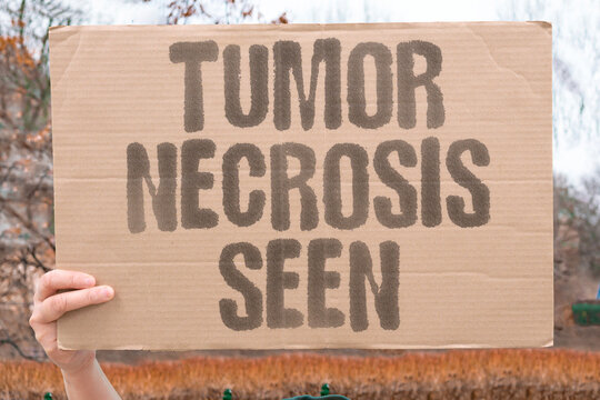 "Tumor Necrosis Seen" Dead cells are visible within the malignancy. NECROSIS. HYPOXIA. AGGRESSIVE. PROGNOSIS. RESPONSE.