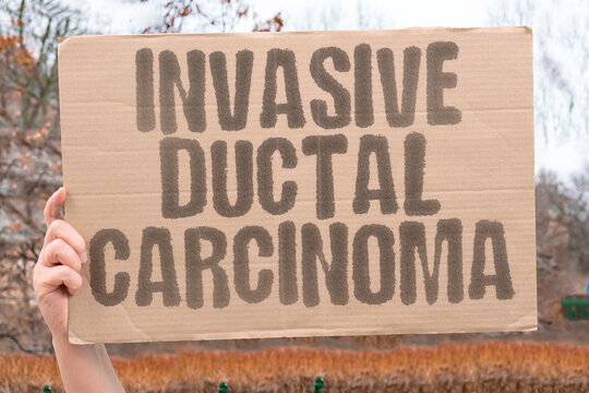 "Invasive Ductal Carcinoma" The most common type of breast cancer. IDC. HISTOLOGY. COMMON. SUBTYPE. AGGRESSIVE.