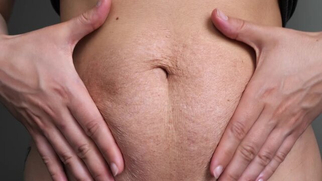 Woman pinching loose skin and stretch marks on her postpartum belly