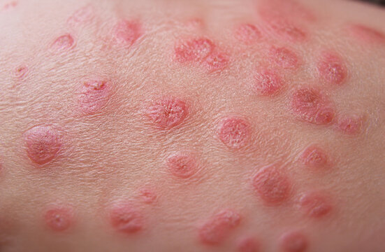 Extreme close-up of human skin with multiple red circular lesions, showing viral rash symptoms, chickenpox, monkeypox lesions, hives, ringworm fungal infection, allergic dermatitis, skin eruption
