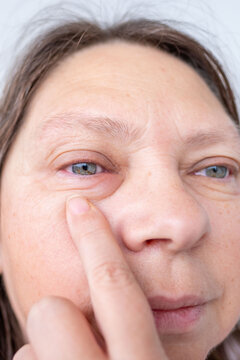 female eye with visible redness, severe swelling, Clinical observation periorbital edema, inflammatory process, allergic or infectious eye condition, ocular inflammation and trauma, blepharitis