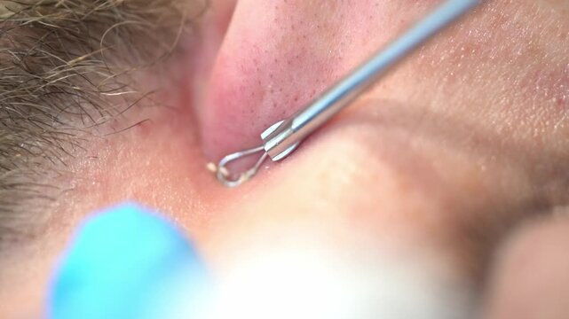 Comedone Extractor Removing Sebum Beside Nose