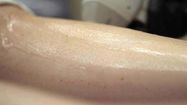 Close Up of Laser Hair Removal Handpiece on Skin