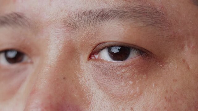 Macro close up of multiple milia keratin cysts and small white bumps under the eye of an Asian person face. Perfect for dermatology and skincare beauty concepts.