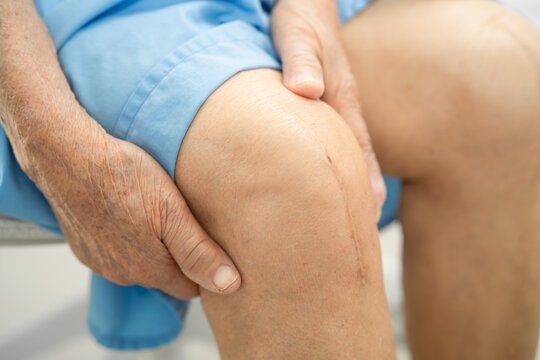 Asian elderly woman patient show her scars surgical total knee joint replacement Suture wound surgery arthroplasty on bed in hospital.