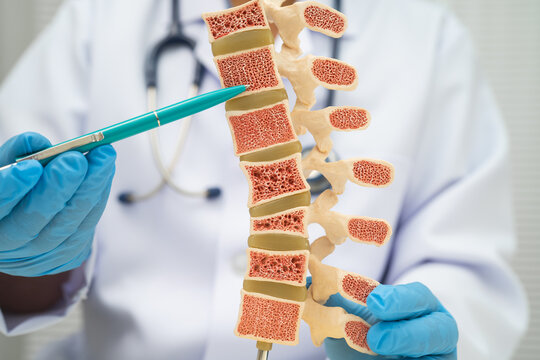 Doctor holding osteoporosis in back bone model.