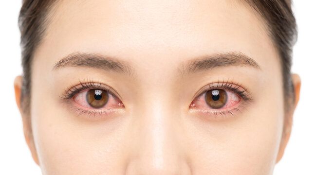花粉症や結膜炎で目が赤く充血した女性の目元 辛い眼精疲労の症状