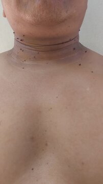 Young Man Showing Skin Tags and Warts on Neck and Chest Area