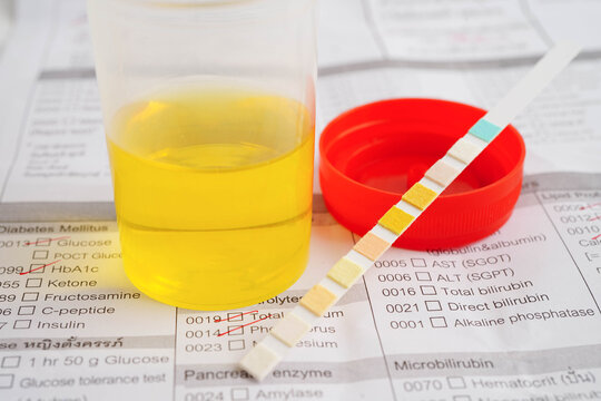 Urinalysis, urine cup with reagent strip pH paper test and comparison chart in laboratory.