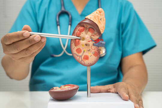Chronic kidney disease, Asian woman with model for treatment urinary system, urology, Estimated glomerular filtration rate eGFR.