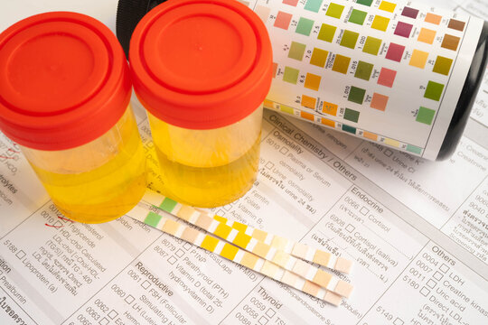 Urinalysis, urine cup with reagent strip pH paper test and comparison chart in laboratory.