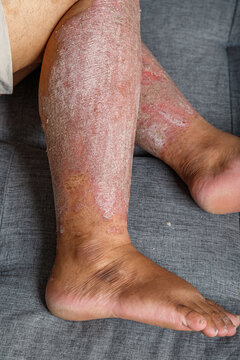 Close-up of inflamed dry scaly skin on a human leg, A chronic skin condition with redness, irritation, and flaky texture for healthcare and dermatology