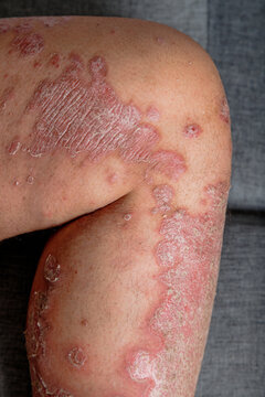 Close-up of inflamed dry scaly skin on a human leg, A chronic skin condition with redness, irritation, and flaky texture for healthcare and dermatology