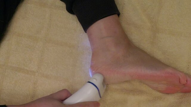 Person using electric callus remover with blue light on swollen foot against beige fabric, includes original audio of device operation.