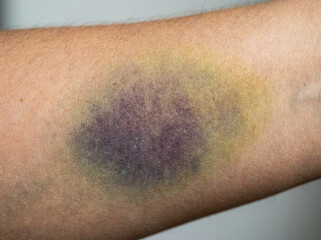 Fototapeta premium Bruise closeup skin showing various colors and textures, indicating injury and healing process