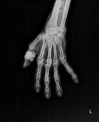Naklejka premium Anterior-posterior (AP) radiograph of a human left hand highlighting chronic gouty arthritis.