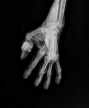 Anterior-posterior (AP) radiograph of a human left hand highlighting chronic gouty arthritis.