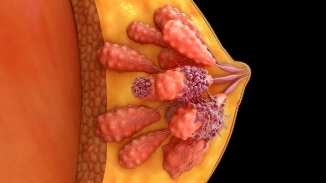 Breast cancer cluster cells on milk glands of 3d illustration
