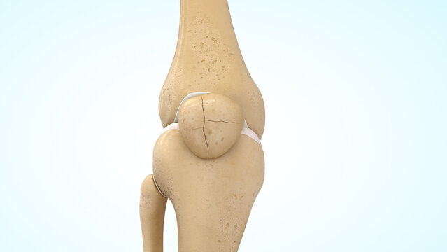 Comminuted undisplaced patella fracture of 3d illustration