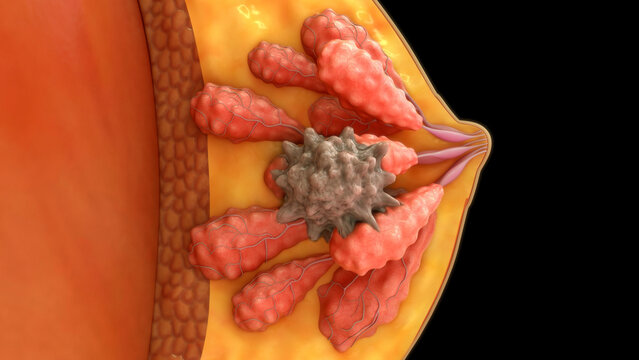 Breast cancer tumor on milk glands of 3d illustration