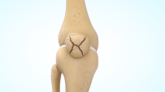 Comminuted displaced patella fracture of 3d illustration