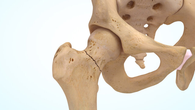 Femur bone non displaced fracture of 3d illustration