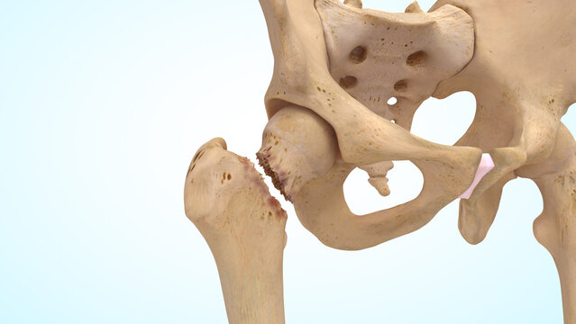 Femur bone displaced fracture of 3d illustration