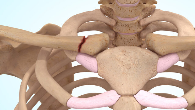 Clavicle bone fracture at the sternoclavicular joint of 3d illustration