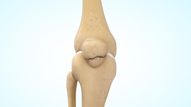 Lower pole patella fracture of 3d illustration