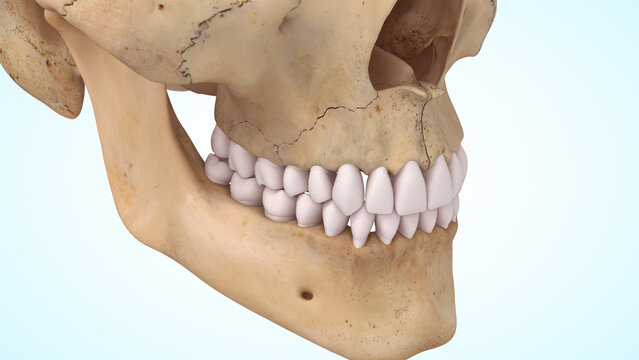 Non-displaced maxilla (upper jaw) fracture of 3d illustration